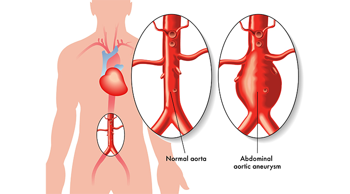 Aortic Aneurysm
