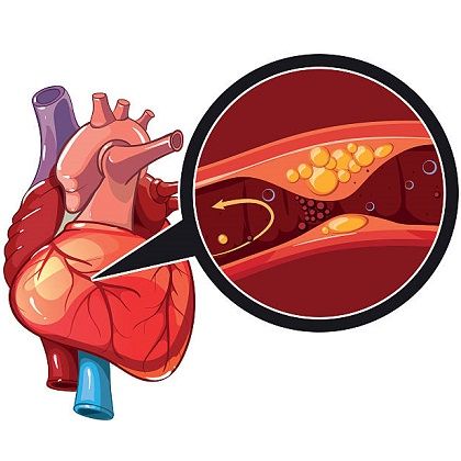 Coronary Artery Disease